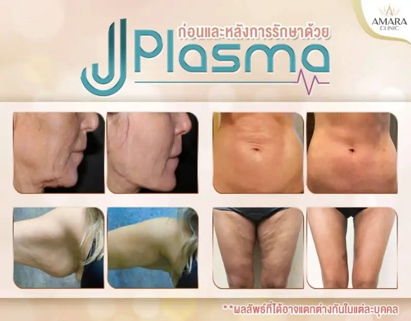 รีวิว J Plasma