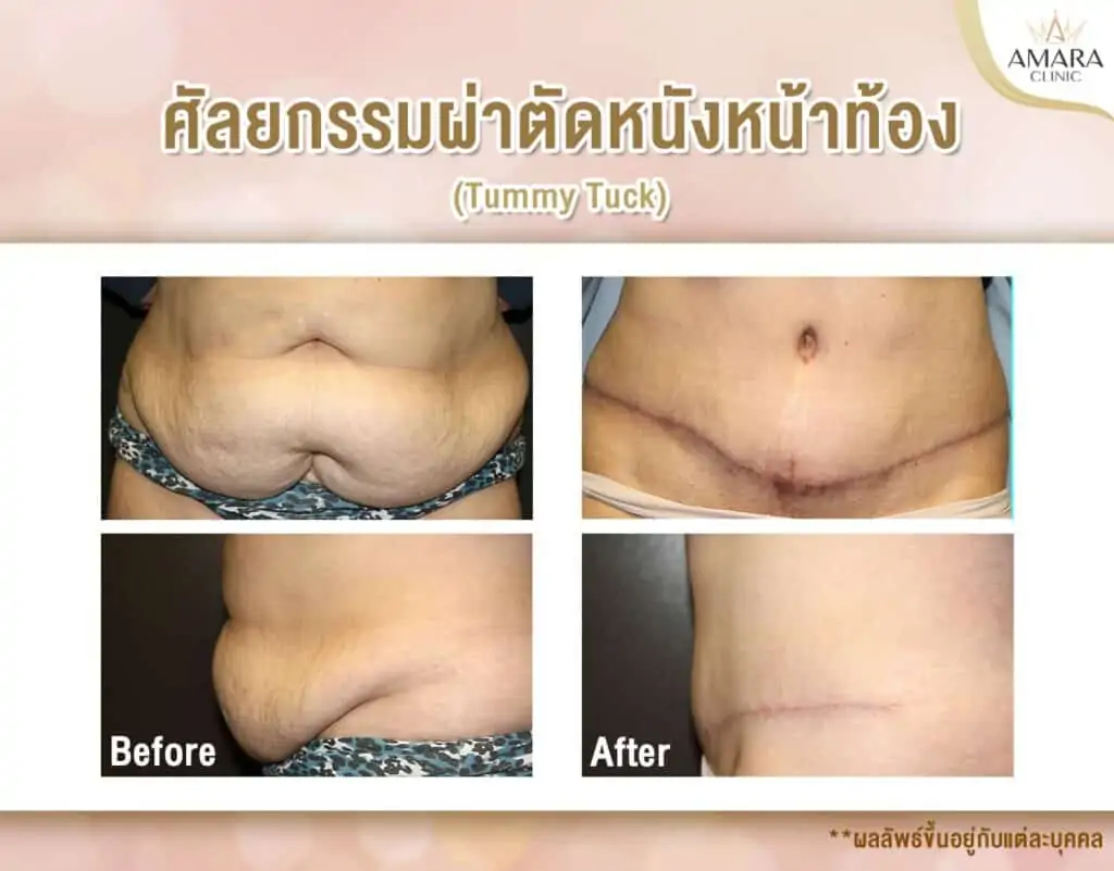 ดูดไขมัน เติมไขมัน Amara Liposuction Center (เอมาร่า คลินิก) โดยแพทย์ผู้มีประสบการณ์