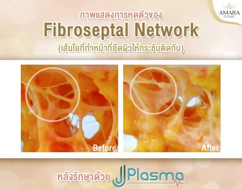 J Plasma ผ่าตัดหนังย้วย