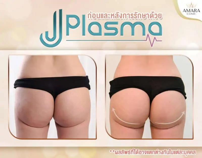 รีวิว J Plasma ก้น