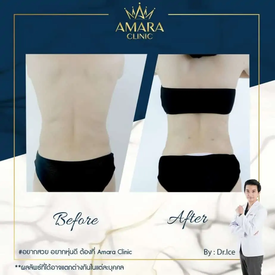 ดูดไขมัน เติมไขมัน Amara Liposuction Center (เอมาร่า คลินิก) โดยแพทย์ผู้มีประสบการณ์