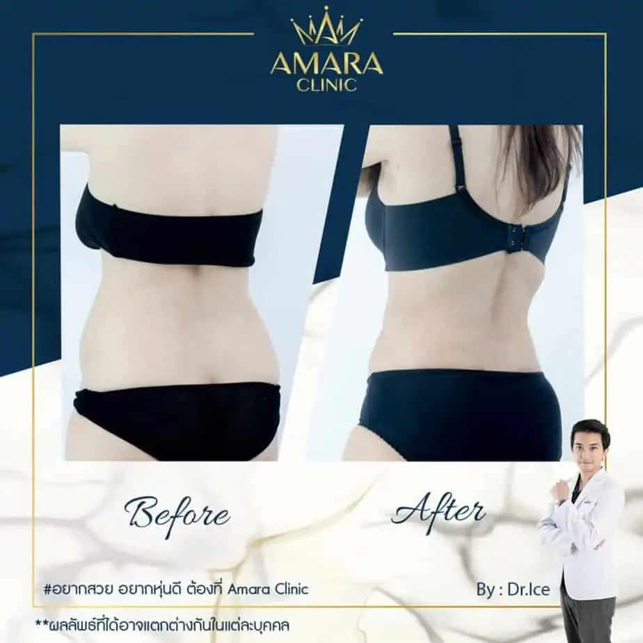 ดูดไขมัน เติมไขมัน Amara Liposuction Center (เอมาร่า คลินิก) โดยแพทย์ผู้มีประสบการณ์