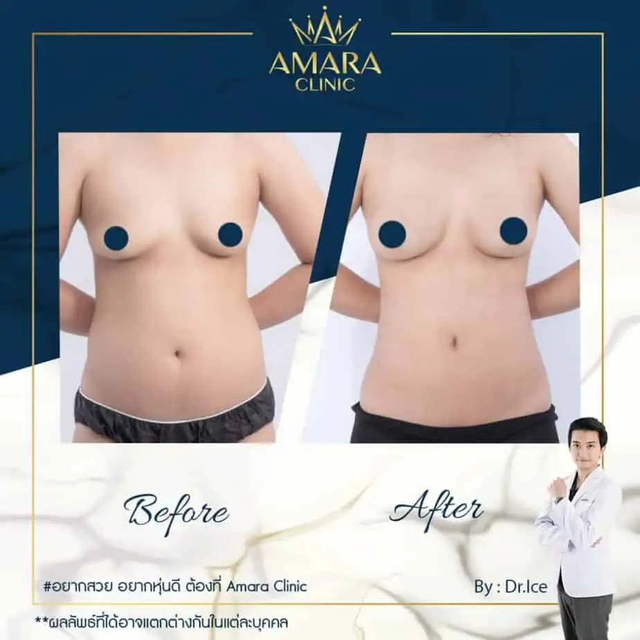 ดูดไขมัน เติมไขมัน Amara Liposuction Center (เอมาร่า คลินิก) โดยแพทย์ผู้มีประสบการณ์
