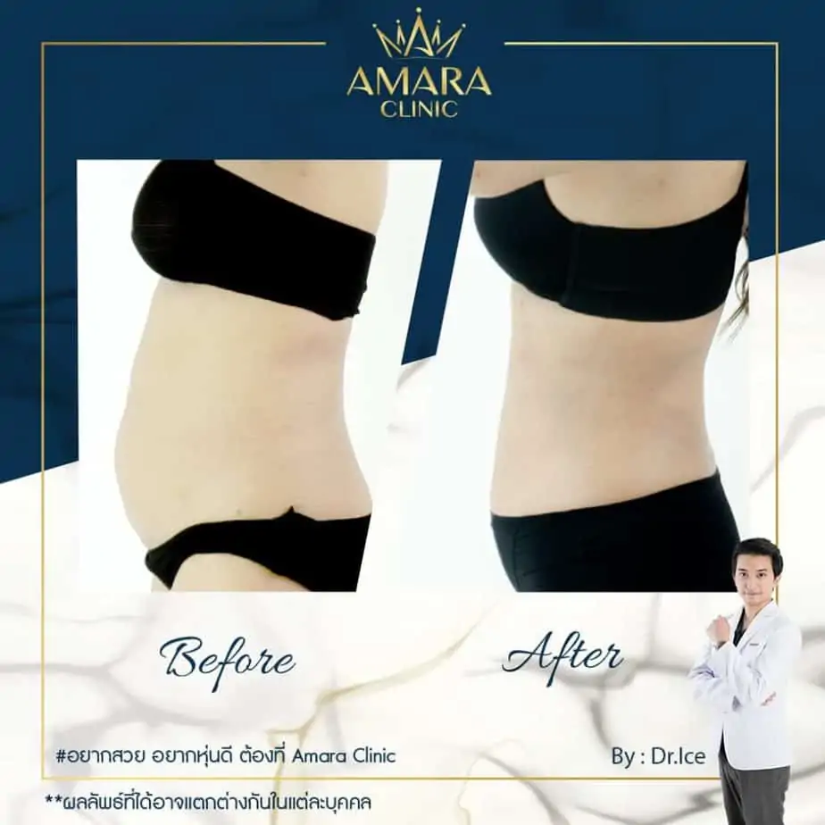ดูดไขมัน เติมไขมัน Amara Liposuction Center (เอมาร่า คลินิก) โดยแพทย์ผู้มีประสบการณ์