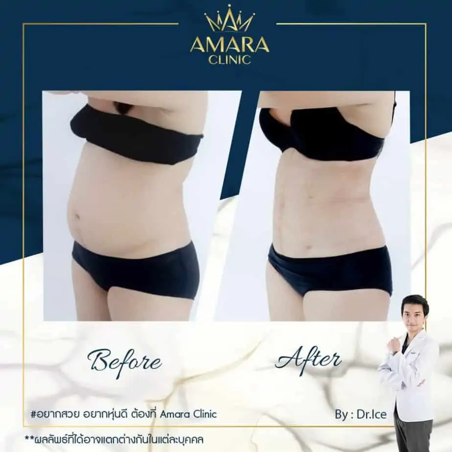 ดูดไขมัน เติมไขมัน Amara Liposuction Center (เอมาร่า คลินิก) โดยแพทย์ผู้มีประสบการณ์