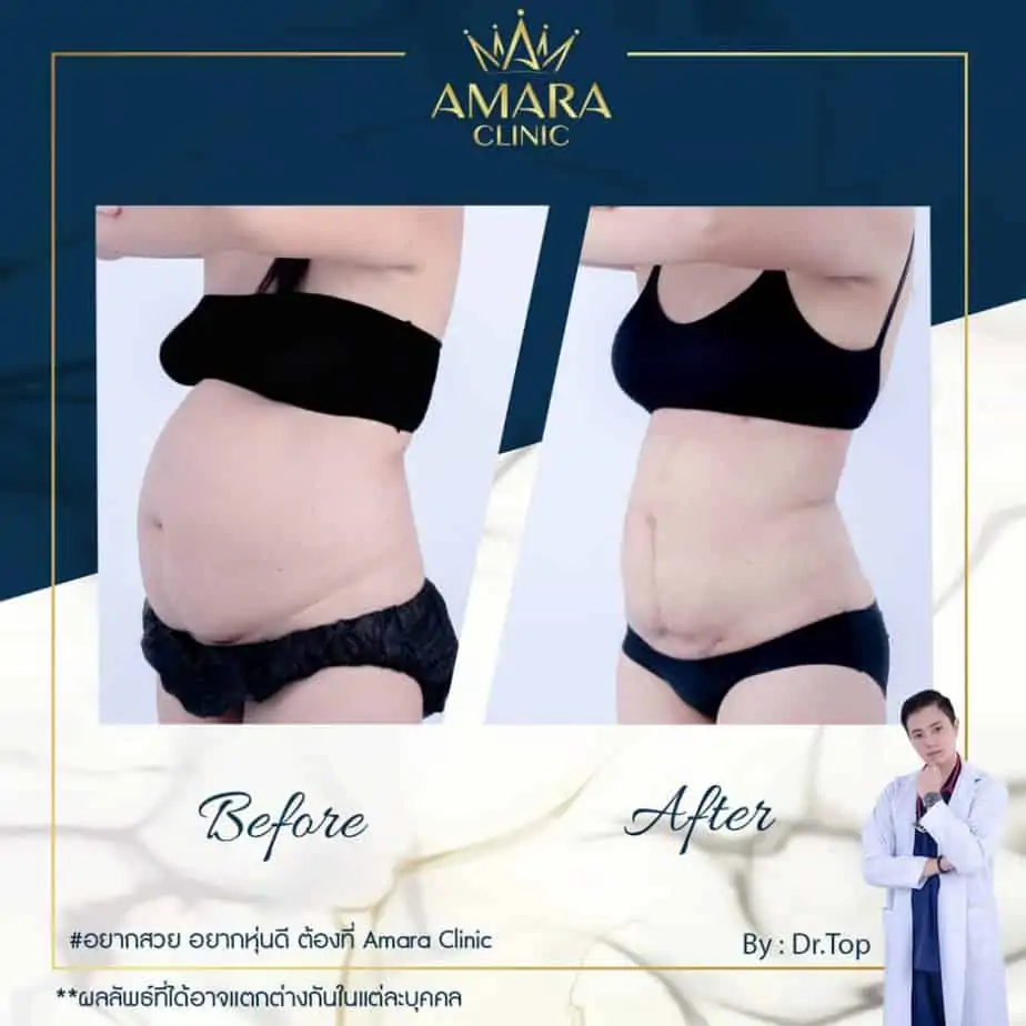 ดูดไขมัน เติมไขมัน Amara Liposuction Center (เอมาร่า คลินิก) โดยแพทย์ผู้มีประสบการณ์