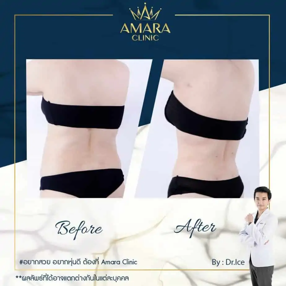 ดูดไขมัน เติมไขมัน Amara Liposuction Center (เอมาร่า คลินิก) โดยแพทย์ผู้มีประสบการณ์