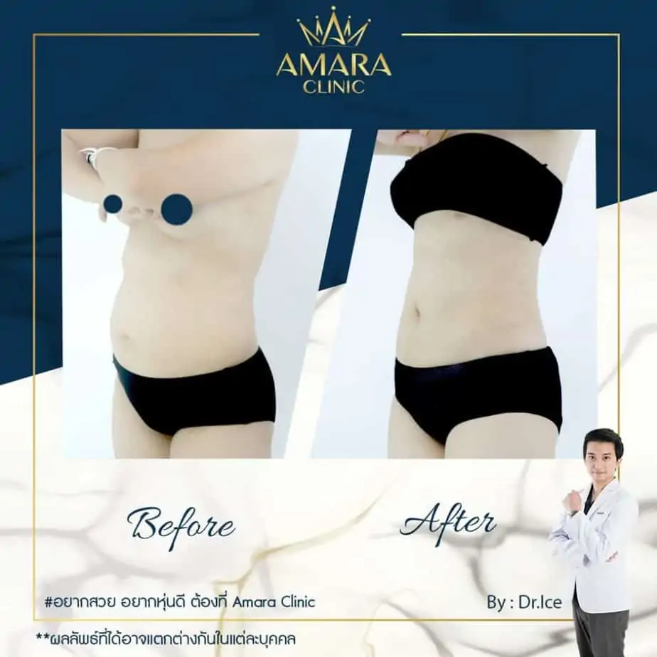 ดูดไขมัน เติมไขมัน Amara Liposuction Center (เอมาร่า คลินิก) โดยแพทย์ผู้มีประสบการณ์