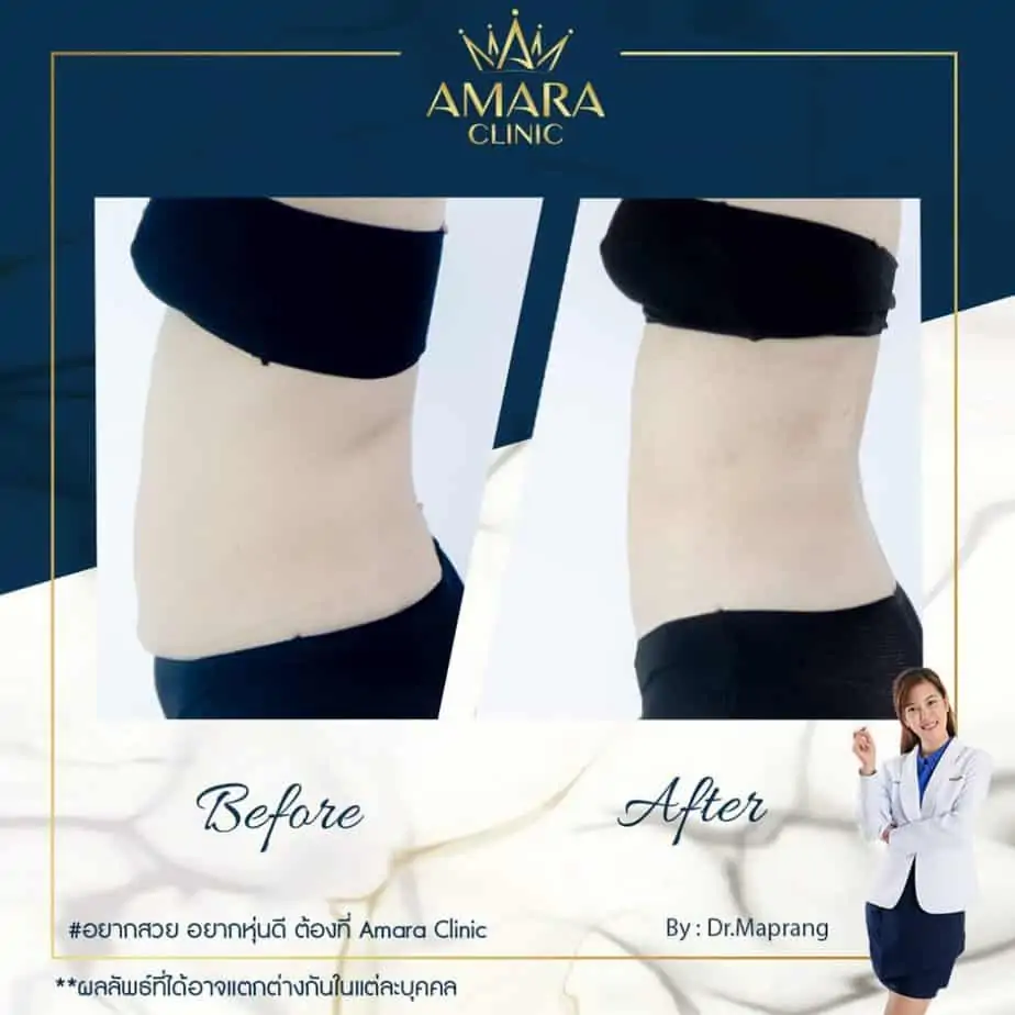 ดูดไขมัน เติมไขมัน Amara Liposuction Center (เอมาร่า คลินิก) โดยแพทย์ผู้มีประสบการณ์