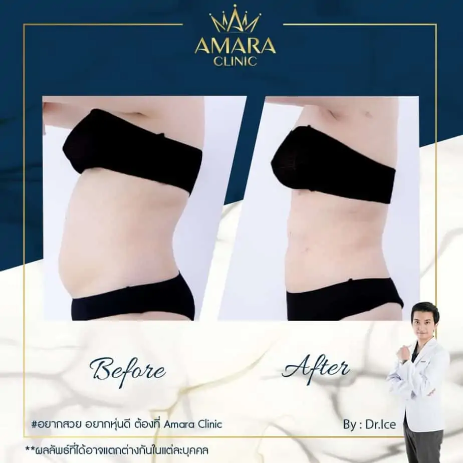 ดูดไขมัน เติมไขมัน Amara Liposuction Center (เอมาร่า คลินิก) โดยแพทย์ผู้มีประสบการณ์