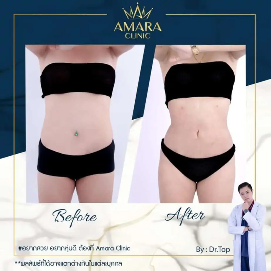 ดูดไขมัน เติมไขมัน Amara Liposuction Center (เอมาร่า คลินิก) โดยแพทย์ผู้มีประสบการณ์