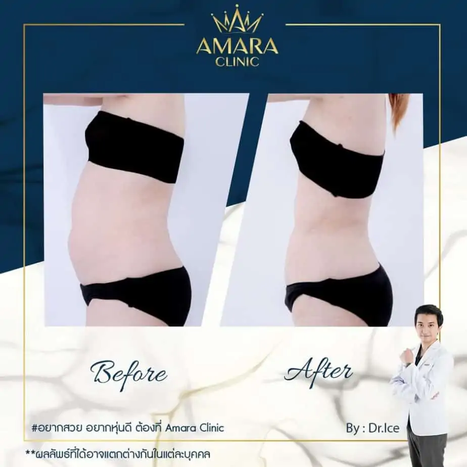 ดูดไขมัน เติมไขมัน Amara Liposuction Center (เอมาร่า คลินิก) โดยแพทย์ผู้มีประสบการณ์