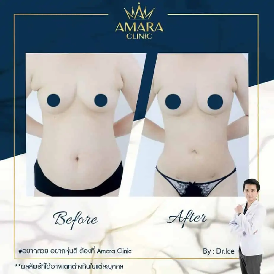 ดูดไขมัน เติมไขมัน Amara Liposuction Center (เอมาร่า คลินิก) โดยแพทย์ผู้มีประสบการณ์