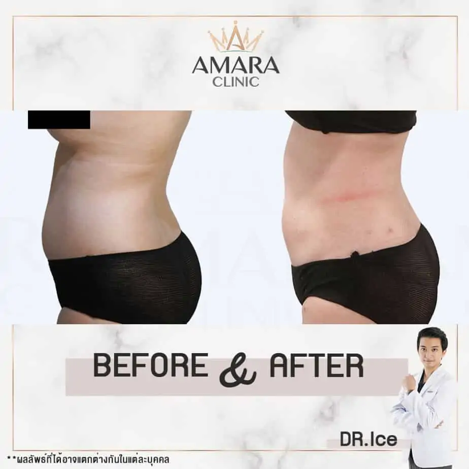 ดูดไขมัน เติมไขมัน Amara Liposuction Center (เอมาร่า คลินิก) โดยแพทย์ผู้มีประสบการณ์