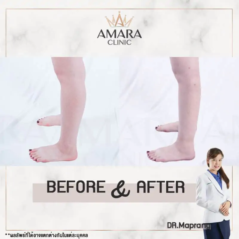 ดูดไขมันน่อง amara