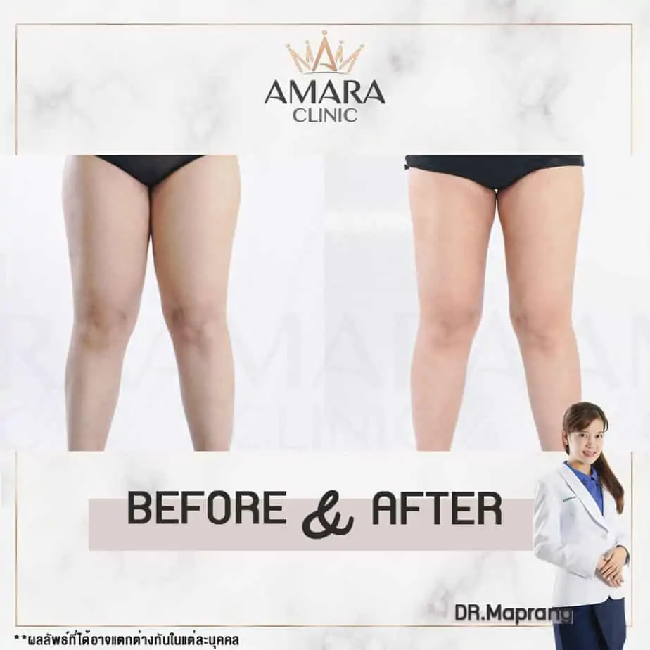 ดูดไขมัน เติมไขมัน Amara Liposuction Center (เอมาร่า คลินิก) โดยแพทย์ผู้มีประสบการณ์
