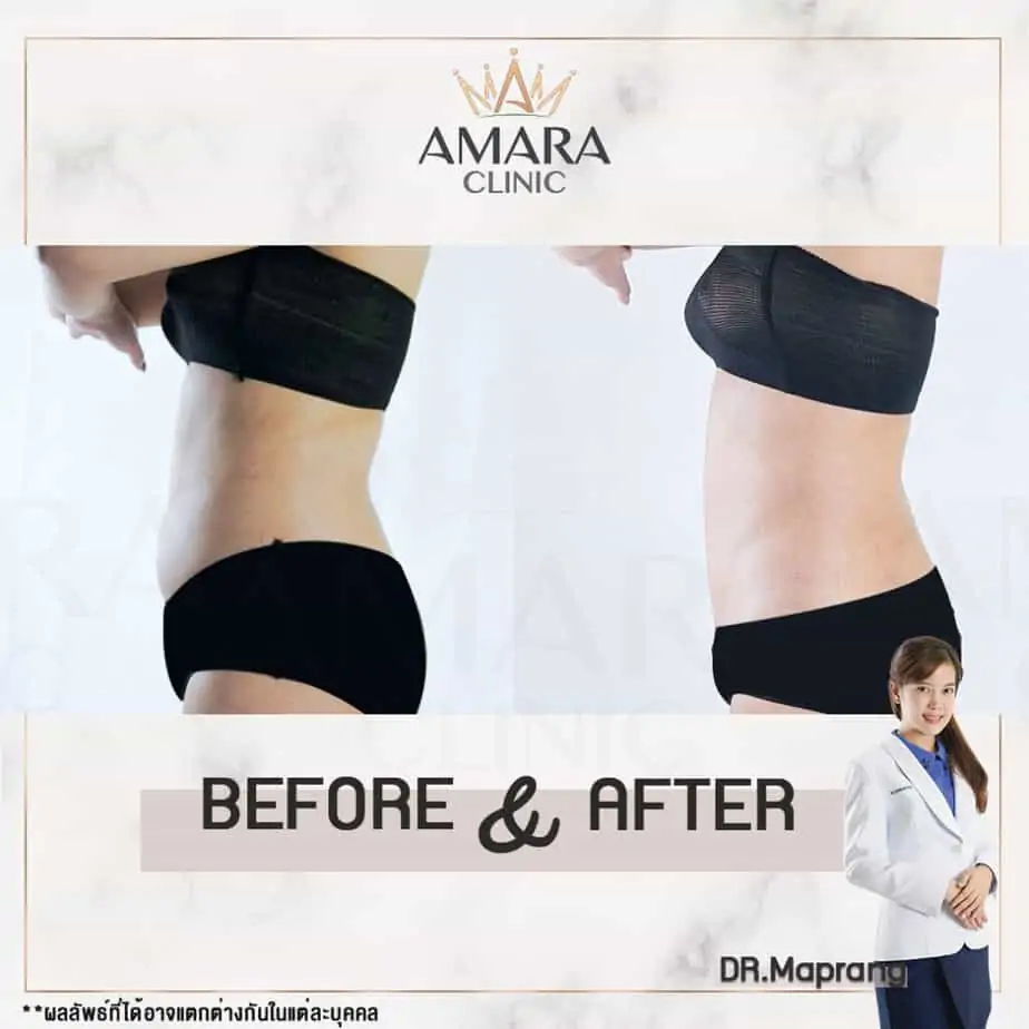 ดูดไขมัน เติมไขมัน Amara Liposuction Center (เอมาร่า คลินิก) โดยแพทย์ผู้มีประสบการณ์