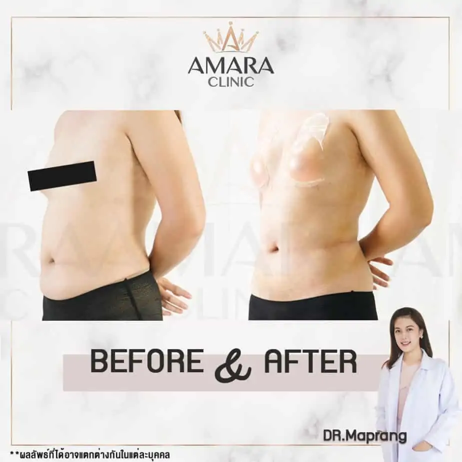 ดูดไขมัน เติมไขมัน Amara Liposuction Center (เอมาร่า คลินิก) โดยแพทย์ผู้มีประสบการณ์