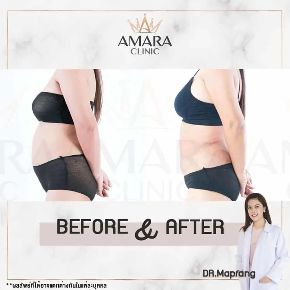 ดูดไขมัน เติมไขมัน Amara Liposuction Center (เอมาร่า คลินิก) โดยแพทย์ผู้มีประสบการณ์