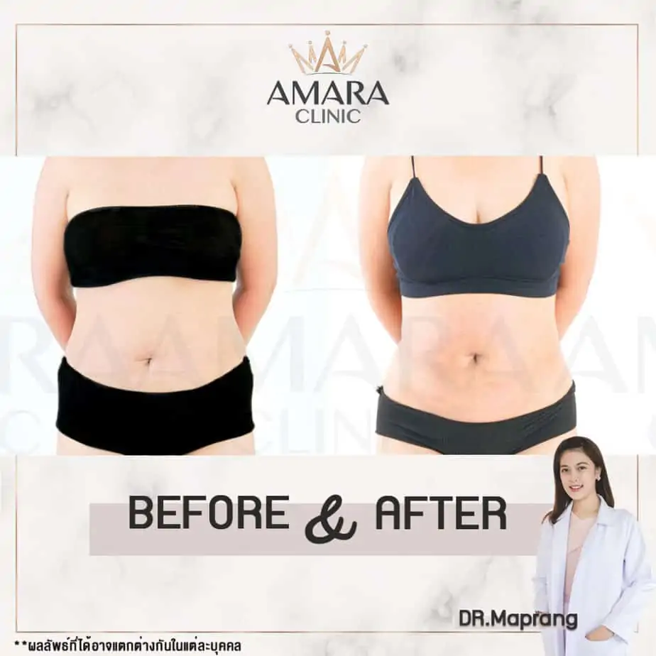 ดูดไขมัน เติมไขมัน Amara Liposuction Center (เอมาร่า คลินิก) โดยแพทย์ผู้มีประสบการณ์