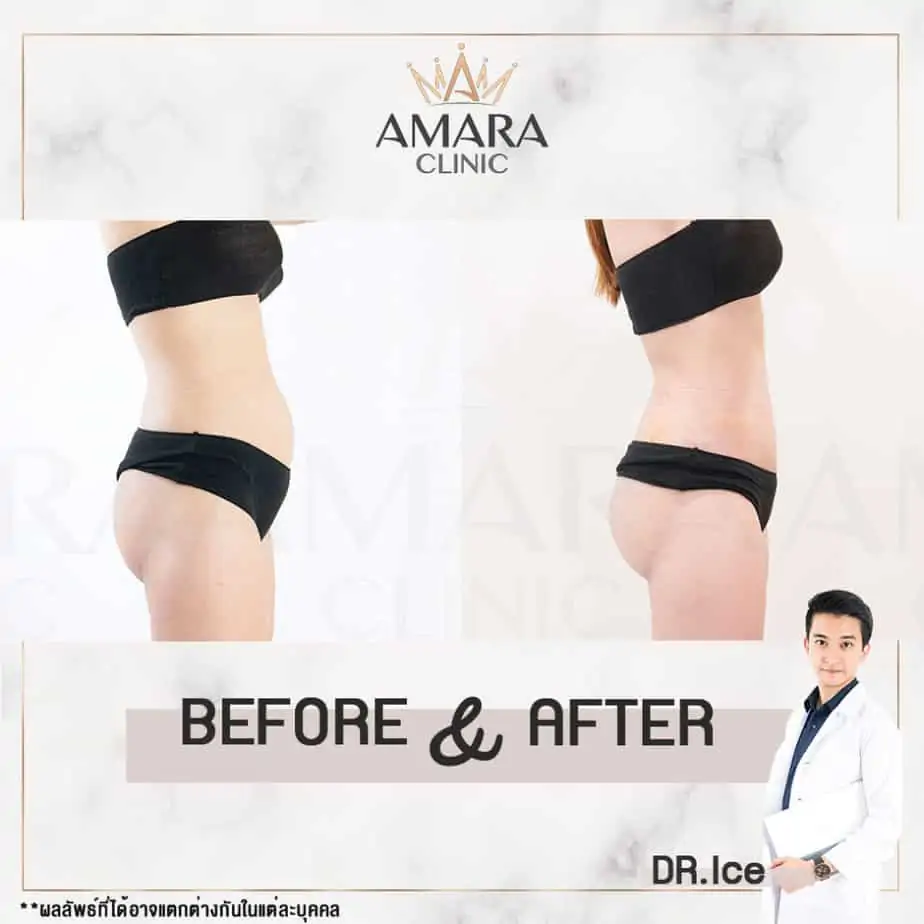 ดูดไขมัน เติมไขมัน Amara Liposuction Center (เอมาร่า คลินิก) โดยแพทย์ผู้มีประสบการณ์