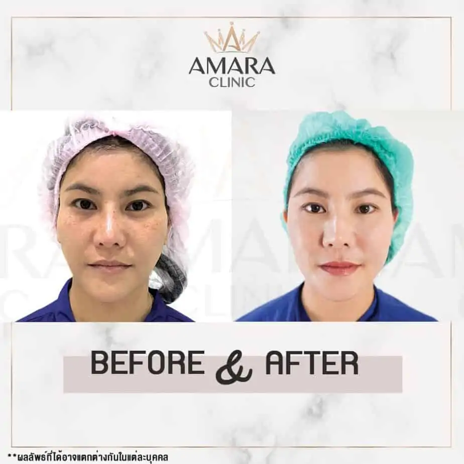 ดูดไขมัน เติมไขมัน Amara Liposuction Center (เอมาร่า คลินิก) โดยแพทย์ผู้มีประสบการณ์