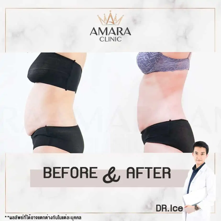 ดูดไขมัน เติมไขมัน Amara Liposuction Center (เอมาร่า คลินิก) โดยแพทย์ผู้มีประสบการณ์