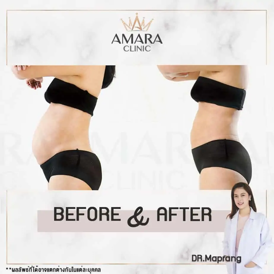 ดูดไขมัน เติมไขมัน Amara Liposuction Center (เอมาร่า คลินิก) โดยแพทย์ผู้มีประสบการณ์