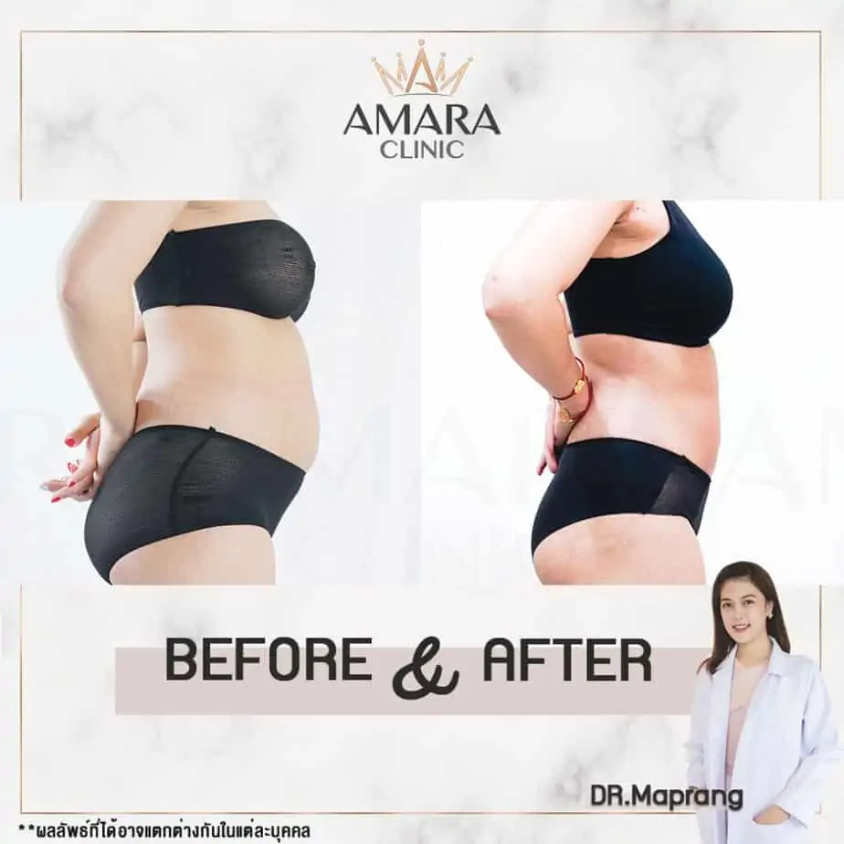 ดูดไขมัน เติมไขมัน Amara Liposuction Center (เอมาร่า คลินิก) โดยแพทย์ผู้มีประสบการณ์