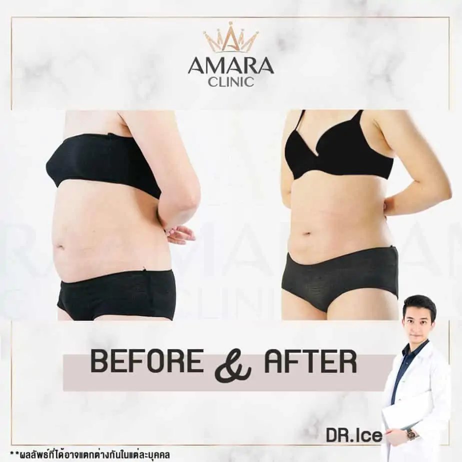 ดูดไขมัน เติมไขมัน Amara Liposuction Center (เอมาร่า คลินิก) โดยแพทย์ผู้มีประสบการณ์