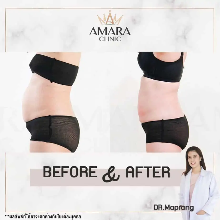 ดูดไขมัน เติมไขมัน Amara Liposuction Center (เอมาร่า คลินิก) โดยแพทย์ผู้มีประสบการณ์