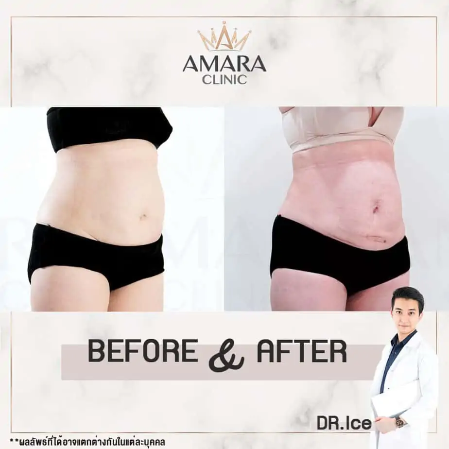 ดูดไขมัน เติมไขมัน Amara Liposuction Center (เอมาร่า คลินิก) โดยแพทย์ผู้มีประสบการณ์