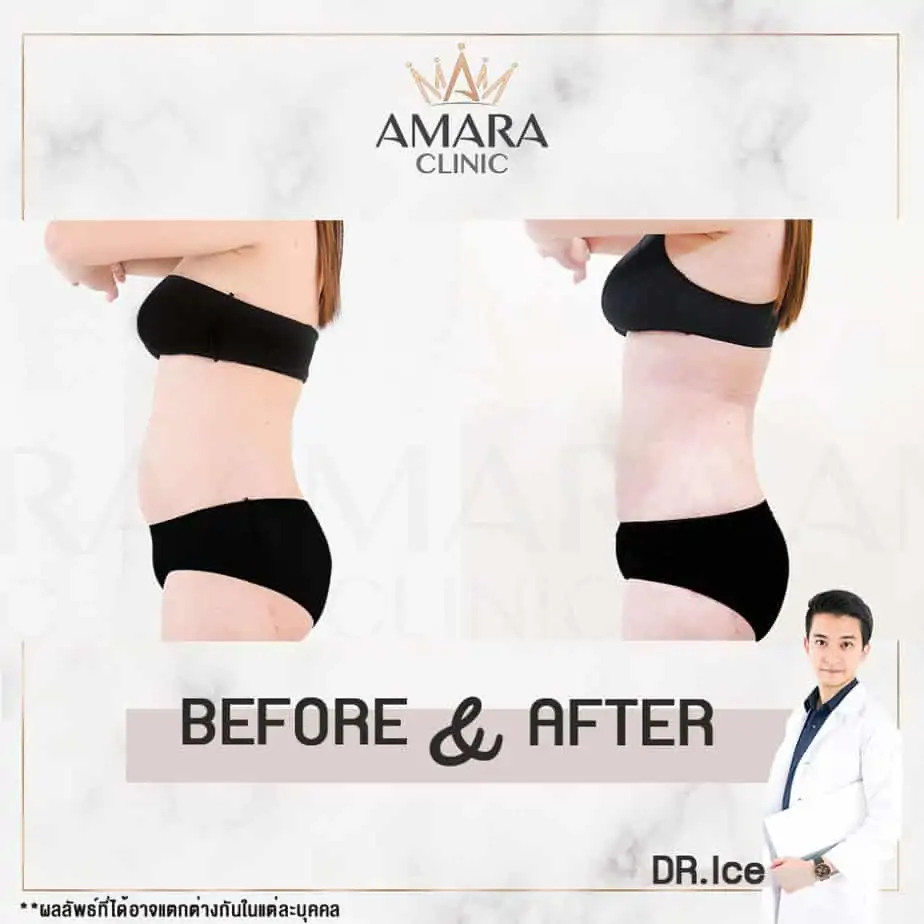 ดูดไขมัน เติมไขมัน Amara Liposuction Center (เอมาร่า คลินิก) โดยแพทย์ผู้มีประสบการณ์