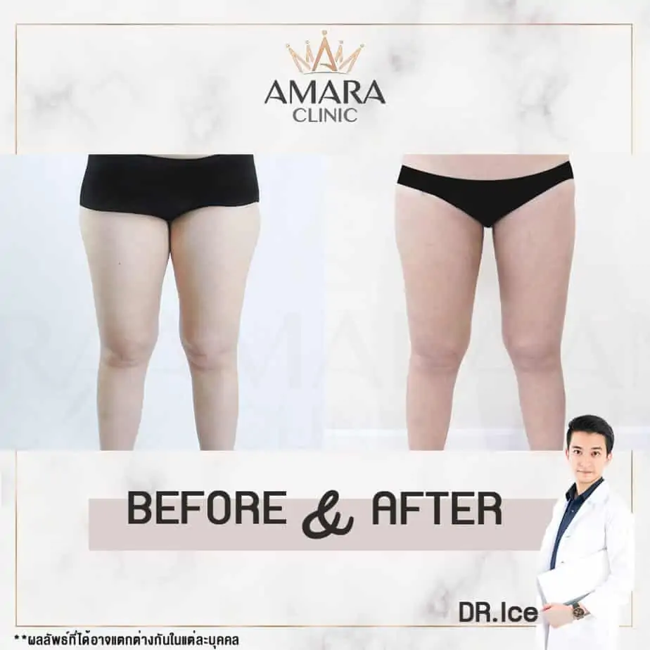 ดูดไขมัน เติมไขมัน Amara Liposuction Center (เอมาร่า คลินิก) โดยแพทย์ผู้มีประสบการณ์