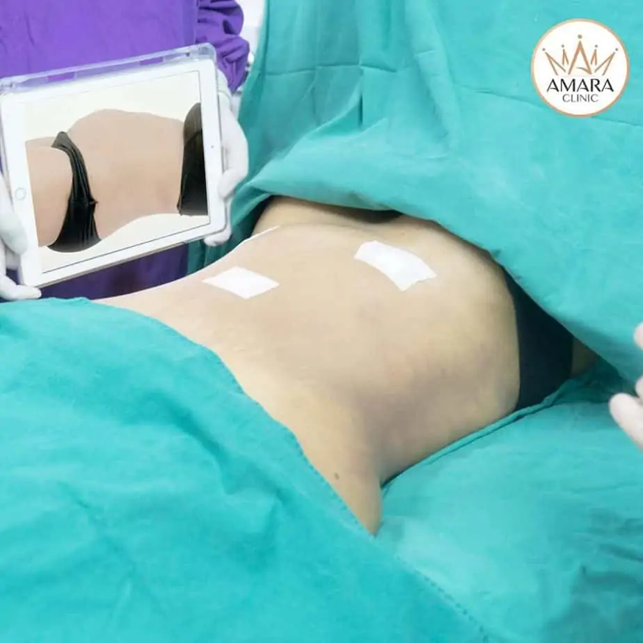 ดูดไขมัน เติมไขมัน Amara Liposuction Center (เอมาร่า คลินิก) โดยแพทย์ผู้มีประสบการณ์