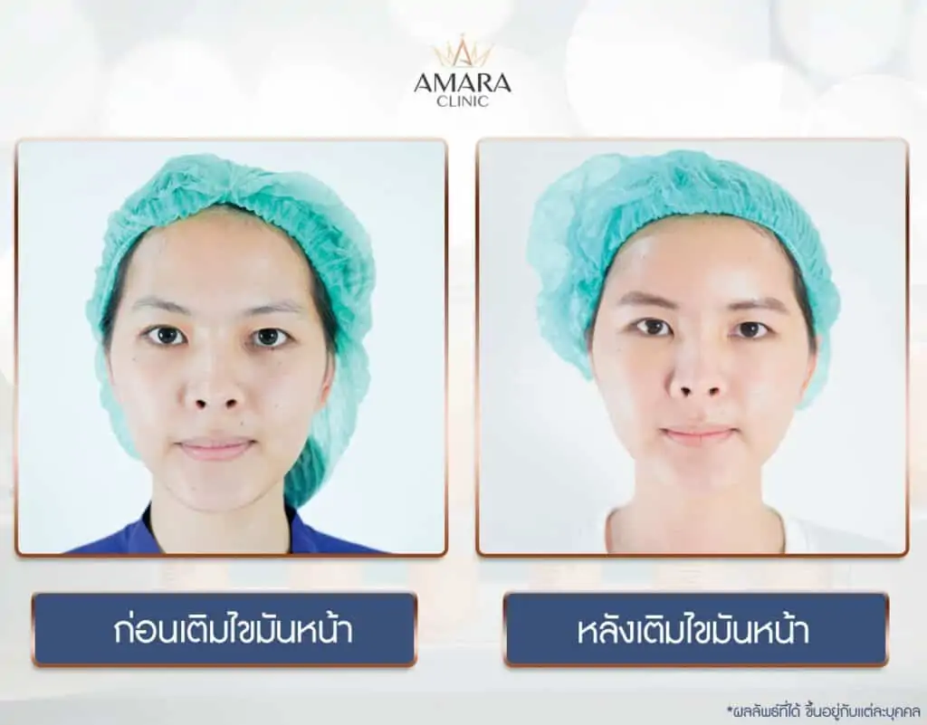ดูดไขมัน เติมไขมัน Amara Liposuction Center (เอมาร่า คลินิก) โดยแพทย์ผู้มีประสบการณ์