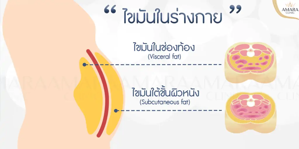 ดูดไขมัน เติมไขมัน Amara Liposuction Center (เอมาร่า คลินิก) โดยแพทย์ผู้มีประสบการณ์