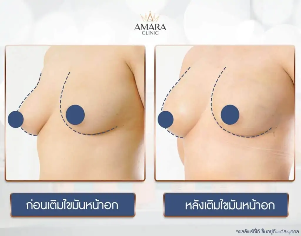 ดูดไขมัน เติมไขมัน Amara Liposuction Center (เอมาร่า คลินิก) โดยแพทย์ผู้มีประสบการณ์