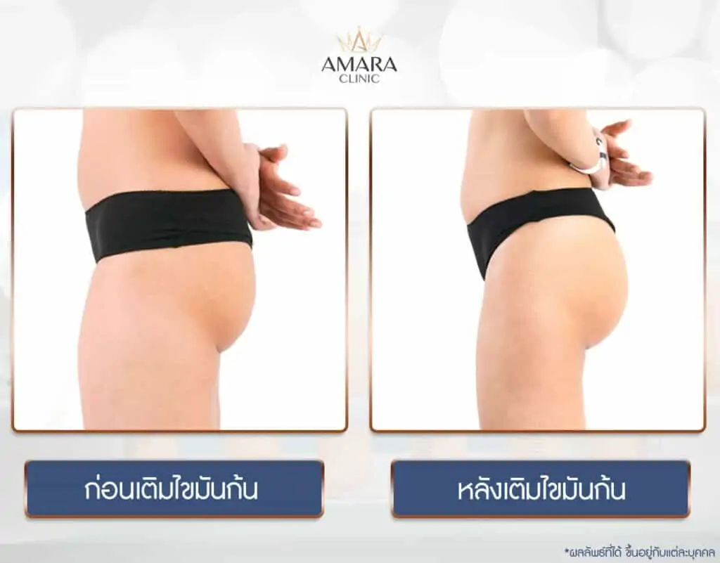 ดูดไขมัน เติมไขมัน Amara Liposuction Center (เอมาร่า คลินิก) โดยแพทย์ผู้มีประสบการณ์