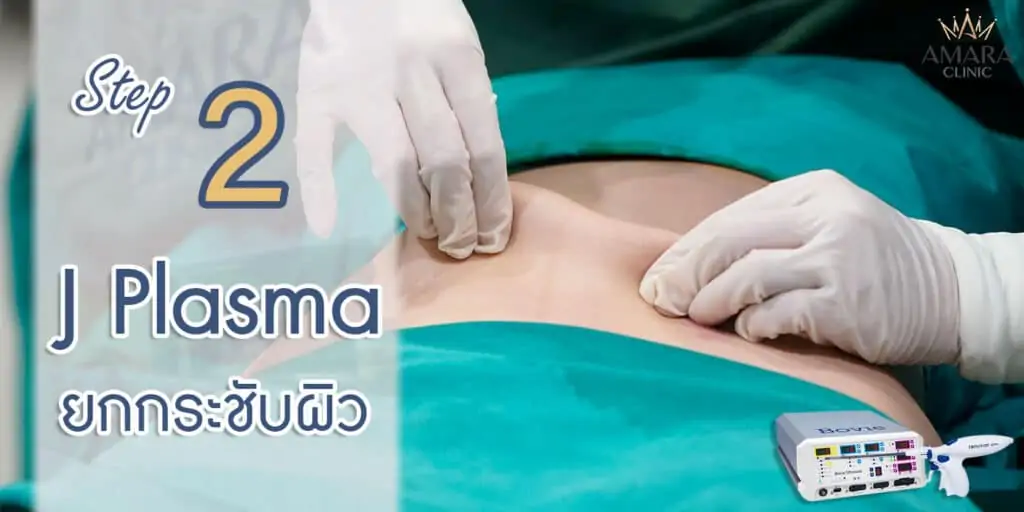 J Plasma ยกกระชับผิวหย่อนคล้อย