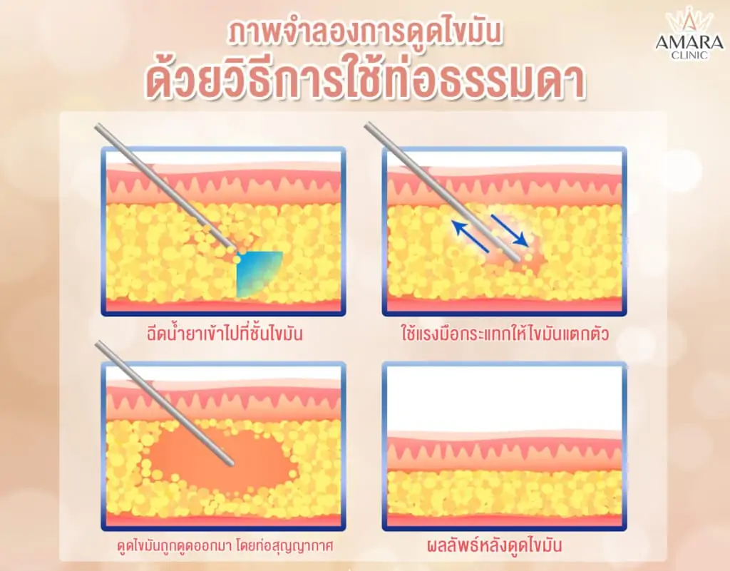 ดูดไขมัน เติมไขมัน Amara Liposuction Center (เอมาร่า คลินิก) โดยแพทย์ผู้มีประสบการณ์