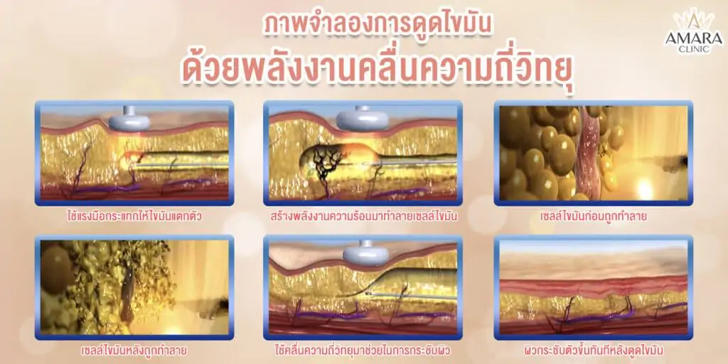 ดูดไขมันด้วยคลื่น RF