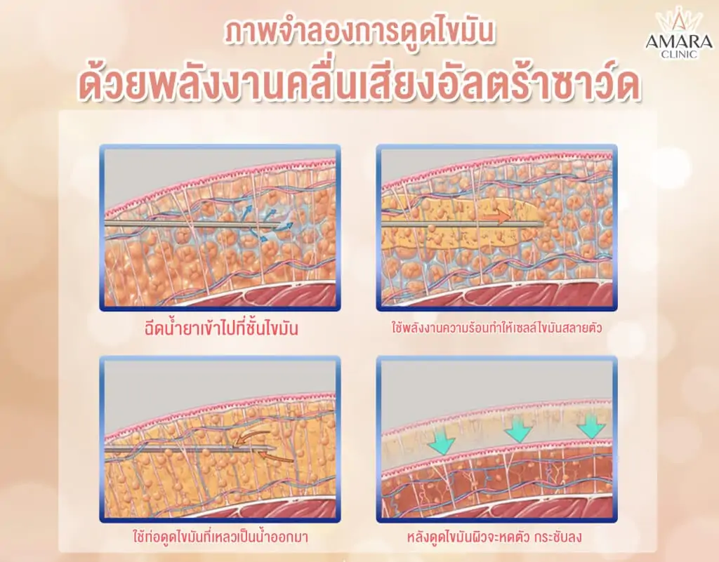 ดูดไขมัน เติมไขมัน Amara Liposuction Center (เอมาร่า คลินิก) โดยแพทย์ผู้มีประสบการณ์