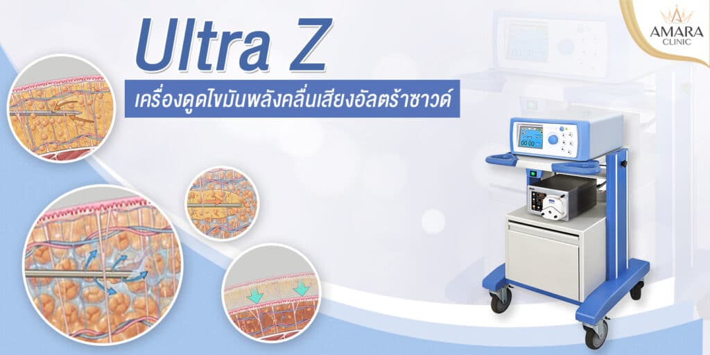 ดูดไขมันพลังคลื่นเสียง Ultra Z