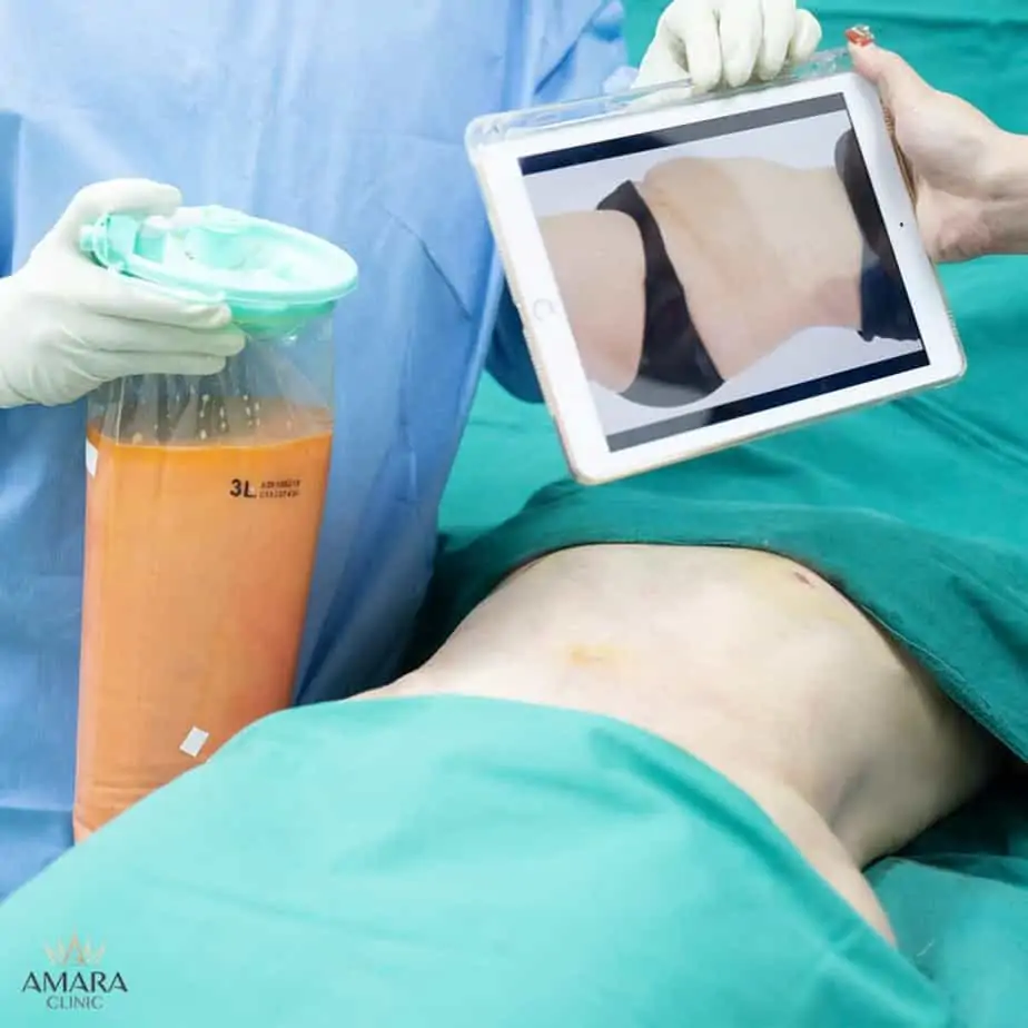 ดูดไขมัน เติมไขมัน Amara Liposuction Center (เอมาร่า คลินิก) โดยแพทย์ผู้มีประสบการณ์