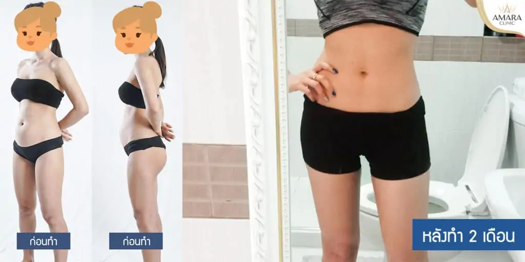 ดูดไขมัน เติมไขมัน Amara Liposuction Center (เอมาร่า คลินิก) โดยแพทย์ผู้มีประสบการณ์