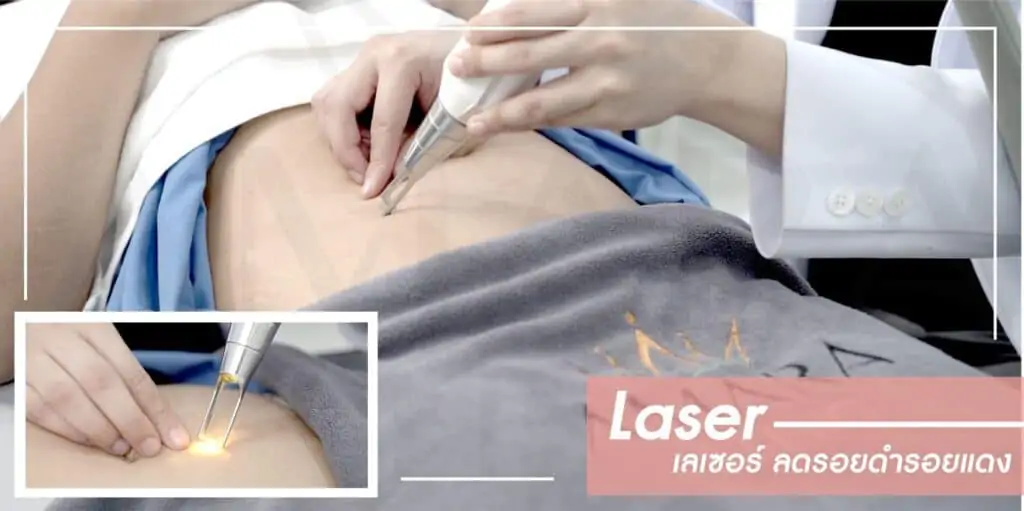 ดูดไขมัน เติมไขมัน Amara Liposuction Center (เอมาร่า คลินิก) โดยแพทย์ผู้มีประสบการณ์