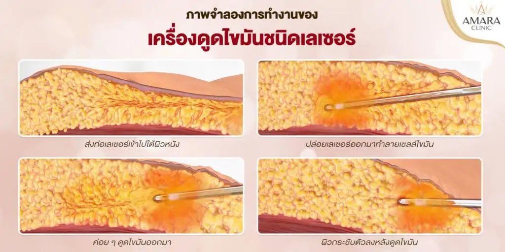 ดูดไขมัน เติมไขมัน Amara Liposuction Center (เอมาร่า คลินิก) โดยแพทย์ผู้มีประสบการณ์