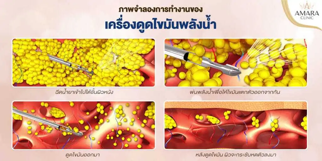 เครื่องดูดไขมันพลังงานน้ำ Body-jet