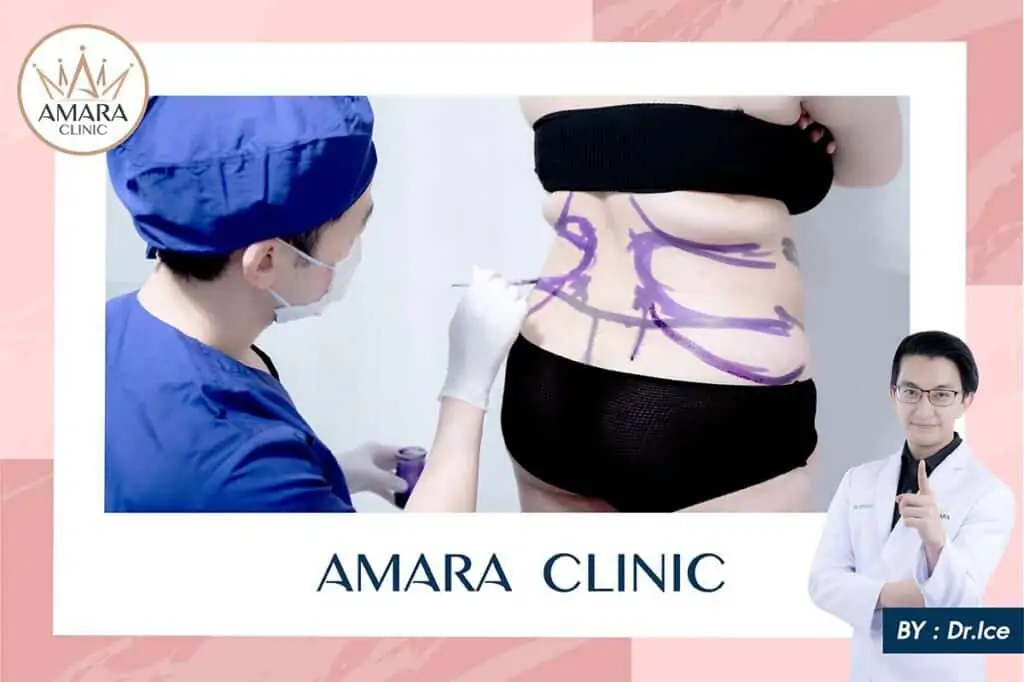 ดูดไขมัน เติมไขมัน Amara Liposuction Center (เอมาร่า คลินิก) โดยแพทย์ผู้มีประสบการณ์